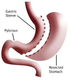 Bariatric Weight Loss